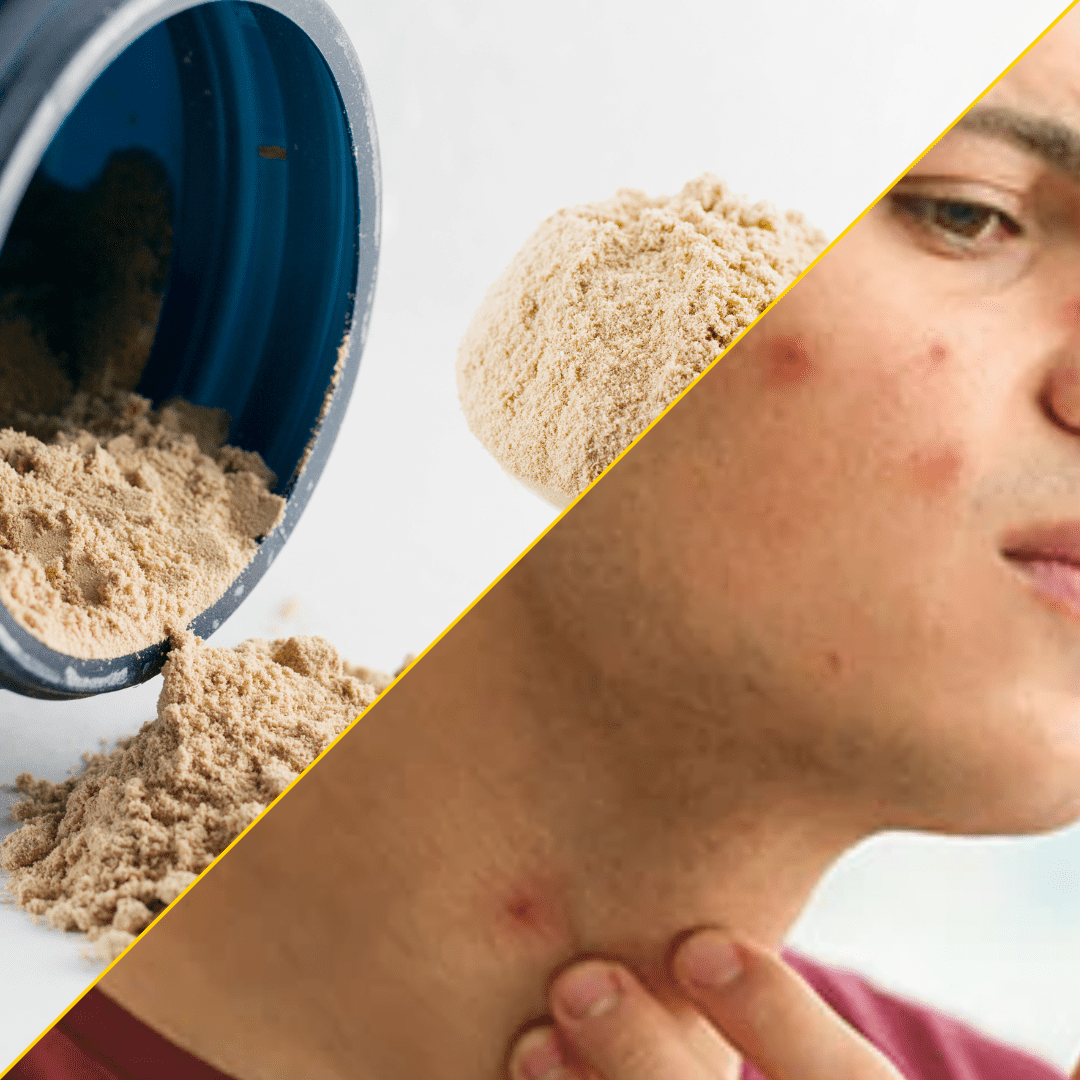Debunking Common Myths About Whey Protein and Acne