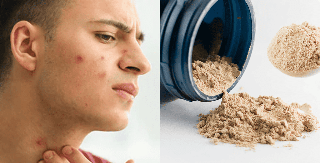 Debunking Common Myths About Whey Protein and Acne